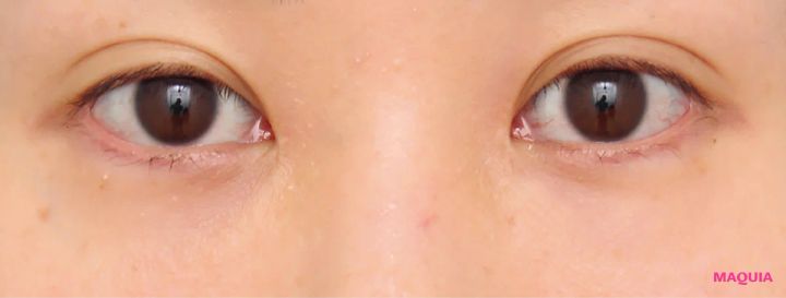 茶くまにおすすめの美容医療の治療 ハムラ法 アフター 3か月後