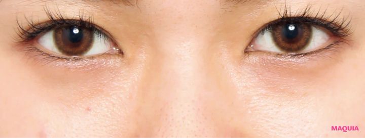 茶くまにおすすめの美容医療の治療 スキンリファインピーリング ビフォー