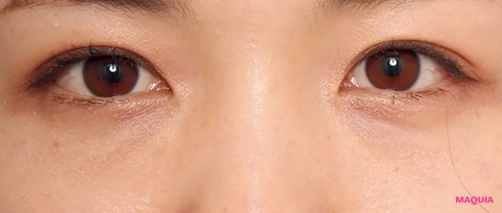 紫くまにおすすめの美容医療の治療 ベビーコラーゲン注射 アフター 1か月後