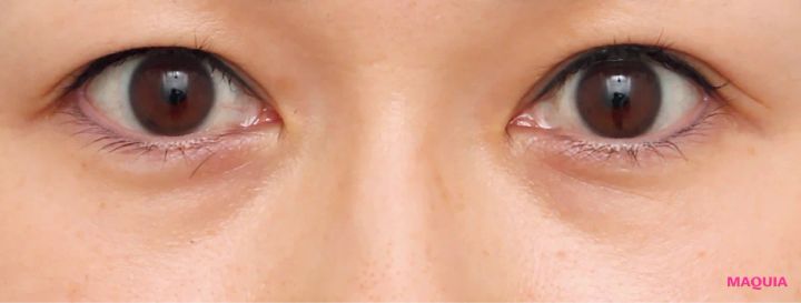 たるみくまにおすすめの美容医療の治療 下眼瞼脱脂術（結膜側） 下眼瞼脂肪注入 ビフォー