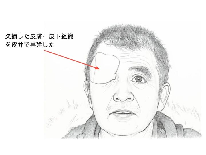 クマ外傷 皮膚欠損 再建