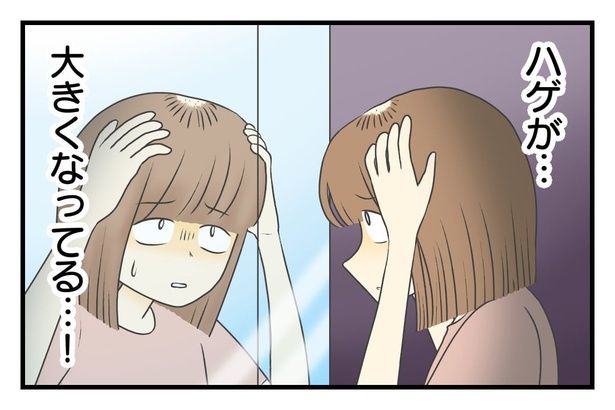 ハゲがどんどん大きくなっていく 8-3 画像提供：春乃おはなさん