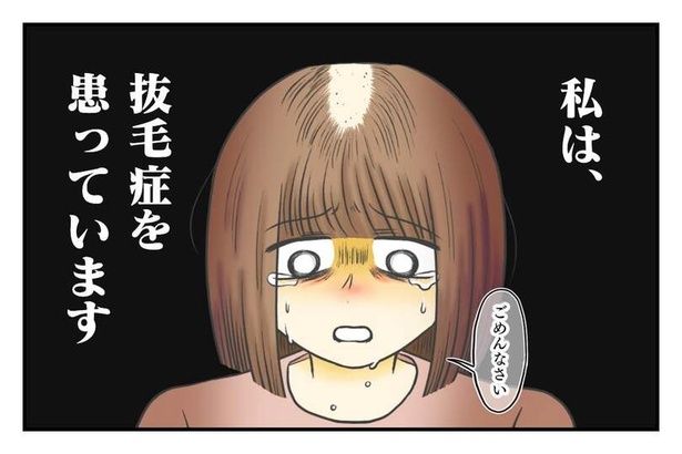 10代で抜毛症を患った女性 画像提供：春乃おはなさん
