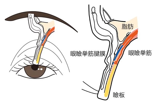 眼瞼挙筋腱膜が伸びたり、瞼板から外れたりして起きる、腱膜性眼瞼下垂の仕組みを示した図。