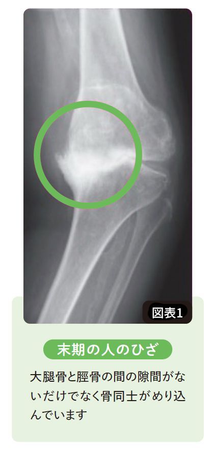 【図表】末期の人のひざ