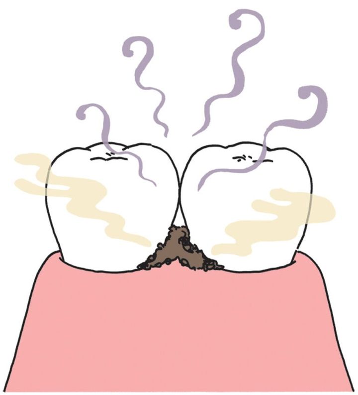 むし歯、歯周病