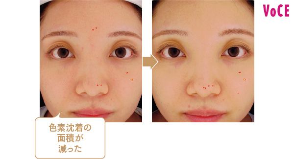 色素沈着の面積が減った