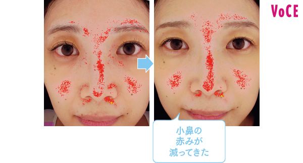 小鼻の赤みが減ってきた