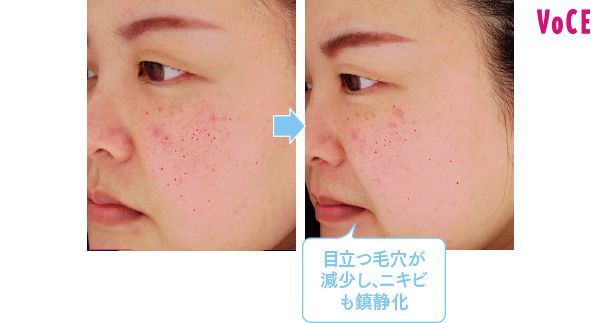 目立つ毛穴が減少し、ニキビも鎮静化