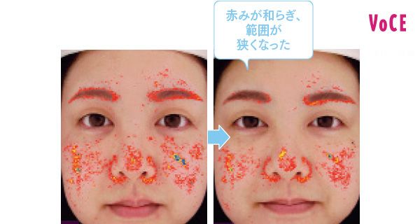 赤みが和らぎ、範囲が狭くなった