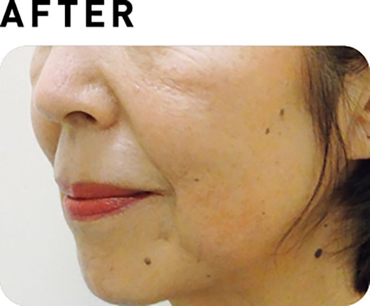 サーマクールCPT【AFTER】