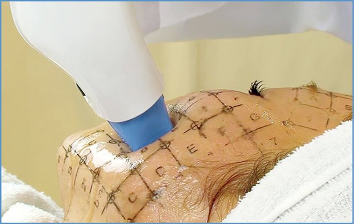 劇的な引き締め効果！しわとたるみの改善に。サーマクールCPT