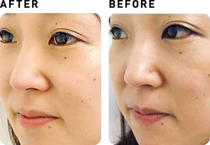 ウルトラ パルス アンコア【BEFORE&AFTER】