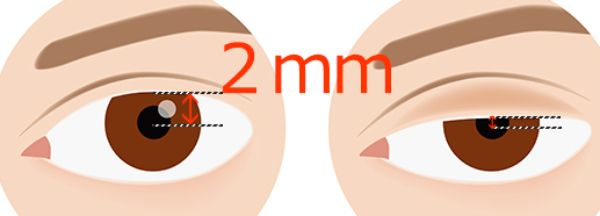 黒目の中心から上瞼のふちまでの距離が2㎜以下になっているかチェックを