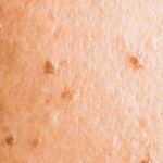 脂漏性角化症（老人性イボ）