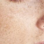 そばかす（雀卵斑）