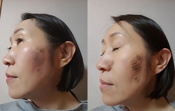 シミ取りレーザ―当てた後の過程