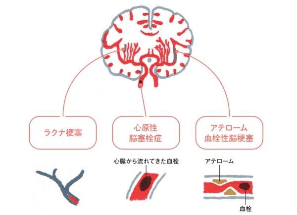 脳梗塞の、代表的な3つのタイプ