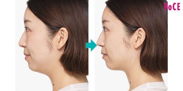 フェイスラインが明らかにすっきり。むくみが取れたような印象！