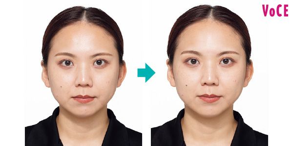 頰が上がり、ほうれい線が薄く。目が開きやすくなり、ぱっちり。