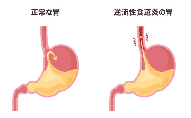 正常・逆流性食道炎の胃