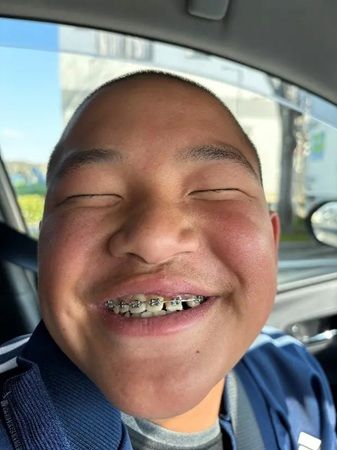 「第21回 ブレーススマイルコンテスト」の受賞作品が決定！矯正歯科治療中の人が対象