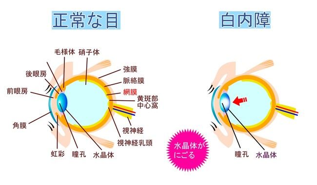 目がかすむのは「老化」だけじゃない！？白内障のサインと予防法【医師解説】