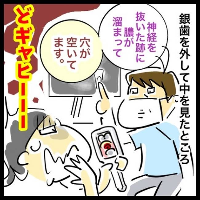 銀歯の下の悲劇／へそ