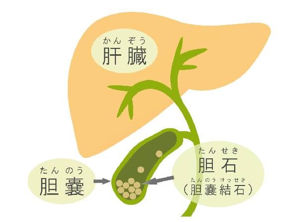 50代女性は「胆石症の4F」に注意！