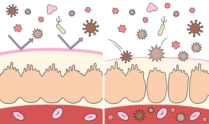 聞いたことあるけど、よくわからない……リーキーガットとはどんな症状？