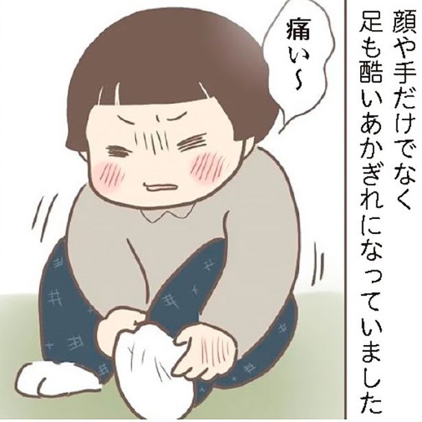 冬はあかぎれになるも、満足に食べさせてもらえず栄養不足なこともあり傷は全然治らず…