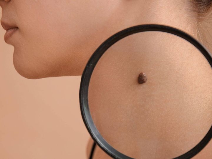 【形成外科医が解説】ほくろを取ってもがんにはなりませんが、ほくろに似た悪性黒色腫には注意が必要です。ほくろと悪性黒色腫の見分け方、セルフチェックのポイントを分かりやすく解説します。（※画像：Shutterstock.com）