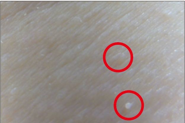 その首のザラつき、イボの赤ちゃんです！