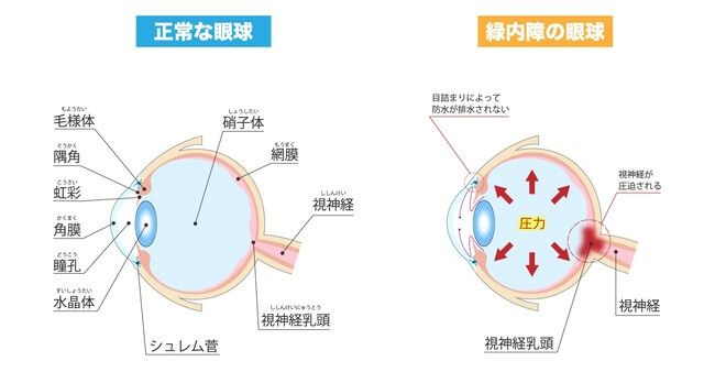 見え方の「欠け」は疲れ目じゃない！？緑内障のサインと予防法【医師解説】