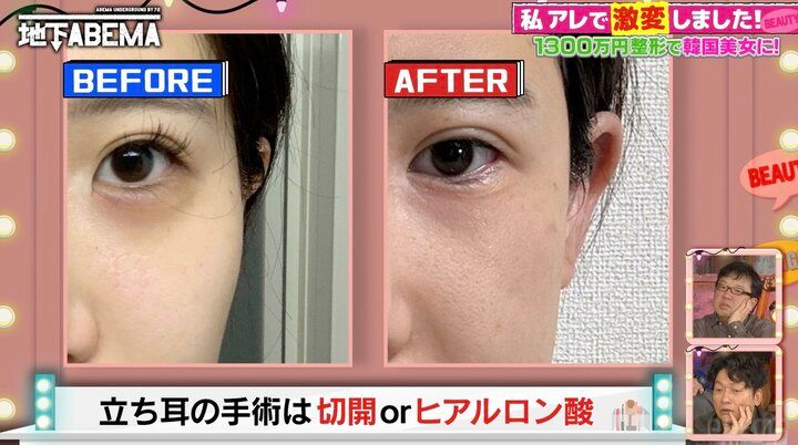 【写真・画像】整形総額1300万円の美女、“立ち耳”整形の効果を明かす「1年で元通りになってしまったけど…」 2枚目