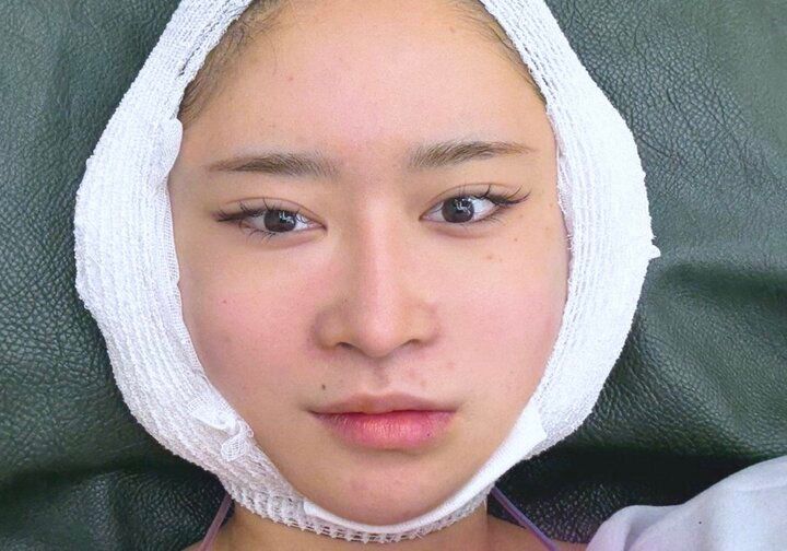 【写真・画像】整形総額1000万円の23歳美女「上から下まで全部」衝撃の整形遍歴を告白「3週間前に顔を剥がしてあげました」 1枚目