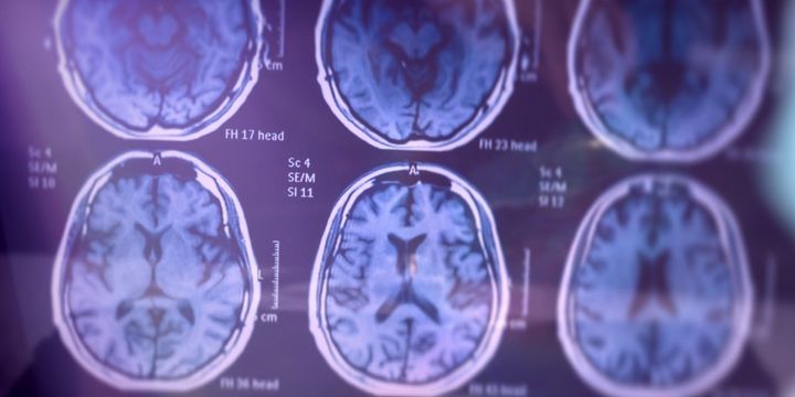 がん患者はアルツハイマー病になりにくいという長年の謎