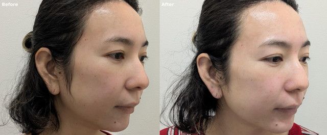 ハイドラフェイシャル