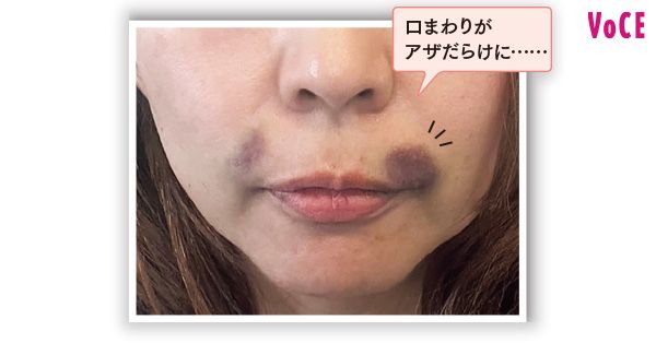 口まわりがアザだらけに……