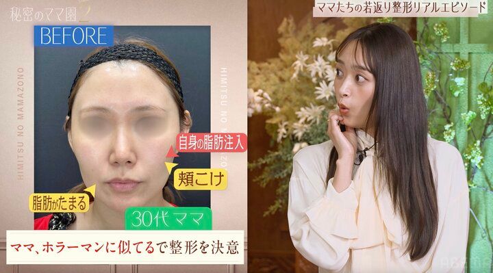 【写真・画像】「ママ、ホラーマンに似てる」で整形を決意…30代ママの整形ビフォーアフターに驚きの声「ナチュラル！」「若返り！」 1枚目