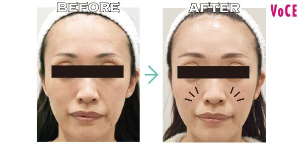 ヒアルロン酸 ・ジュビダームビスタ ボリューマXC／ビフォーアフター