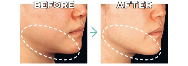 ソフウェーブ／ビフォーアフター