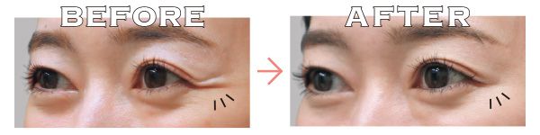 ボトックス注射／ビフォーアフター