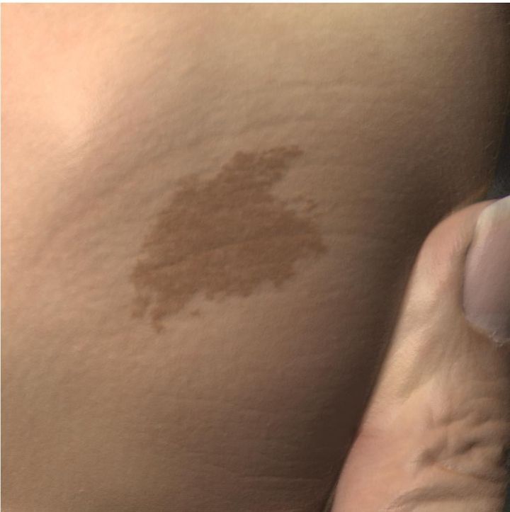 治療前の「扁平（へんぺい）母斑」（よしクリニック提供）