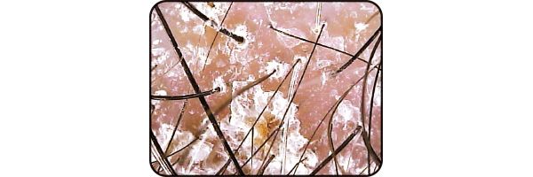 乾燥している頭皮