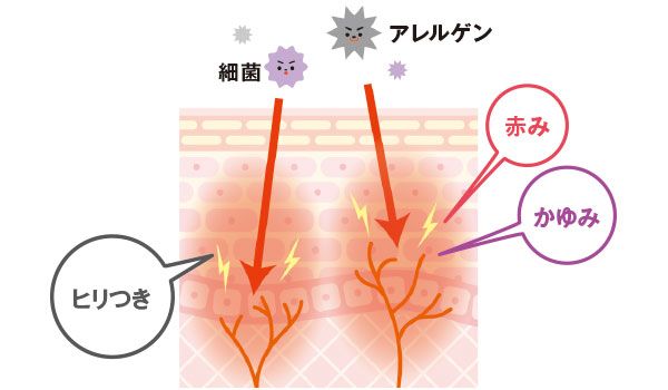 細菌やアレルゲンにより、赤み、かゆみ、ヒリつきなどが出ている肌の状態