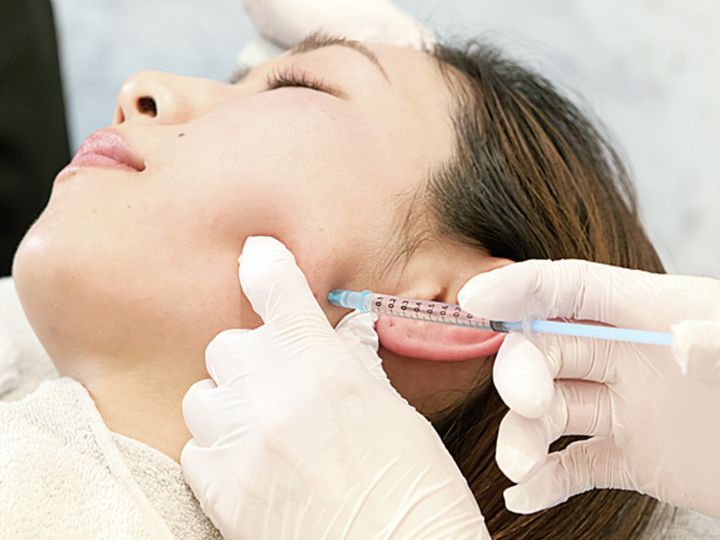 ボトックスリフト