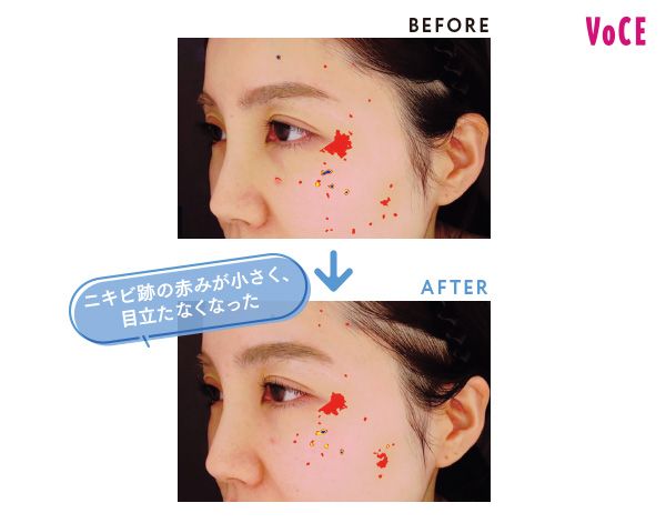 BEFORE AFTER ニキビ跡の赤みが小さく、目立たなくなった