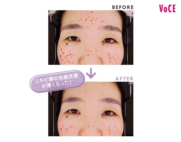 BEFORE AFTER ニキビ跡の色素沈着が薄くなった！