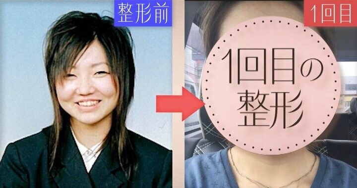 【写真・画像】「整形総額1000万円」19歳から12回繰り返した“顔面課金”の全記録「顔の骨を削り、鼻をフル整形」34歳美女が“お人形フェイス”を手に入れるまで 1枚目